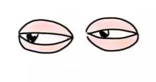 腫眼泡01.jpg 腫眼泡01.jpg