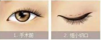 雙眼皮1.jpg 雙眼皮1.jpg