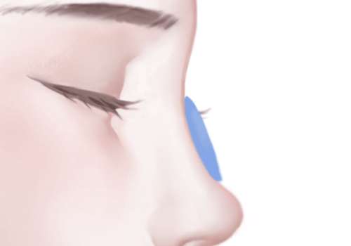 膨體隆鼻.jpg