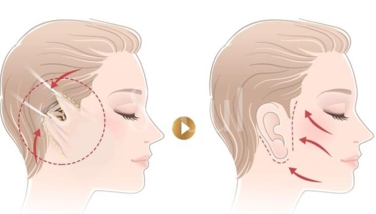 拉皮手術(shù)動(dòng)漫.jpg 拉皮手術(shù)動(dòng)漫.jpg