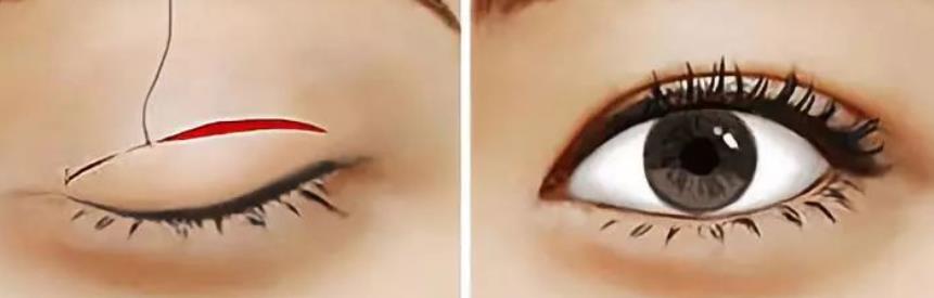 雙眼皮hg4.jpg 雙眼皮hg4.jpg