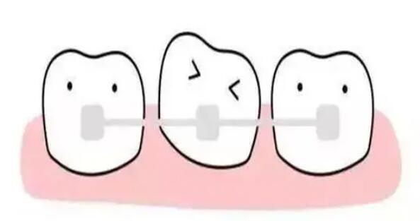 牙齒矯正動(dòng)漫61.jpg 牙齒矯正動(dòng)漫61.jpg