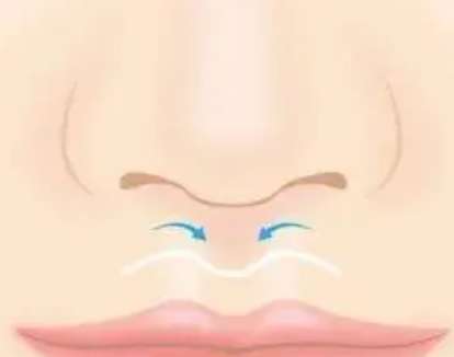 人中縮短 人中縮短