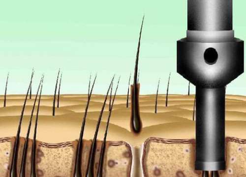 重慶大坪醫(yī)院植發(fā)怎么樣？速來看看收費標(biāo)準(zhǔn)和科室介紹