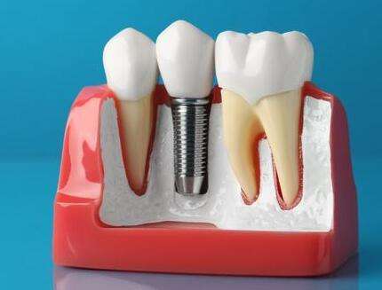 西南醫(yī)院種植牙好還是新橋醫(yī)院種植牙好？分享兩個(gè)醫(yī)院簡介一覽