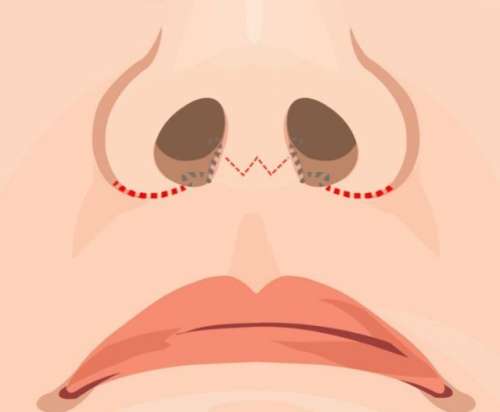 人中縮短 人中縮短