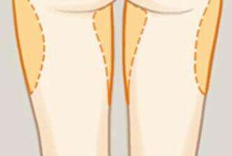 大腿吸脂 大腿吸脂