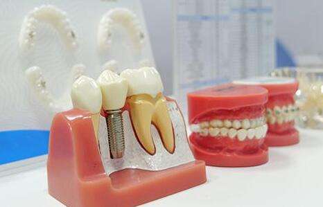 江蘇省口腔醫(yī)院種植牙多少錢？了解費(fèi)用標(biāo)準(zhǔn)，含人氣醫(yī)生介紹