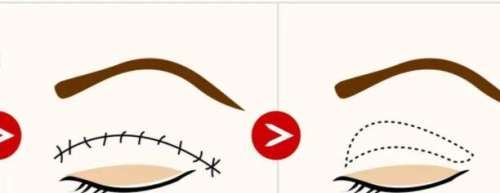 雙眼皮 雙眼皮