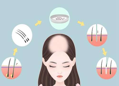 合肥第二人民醫(yī)院植發(fā)費用是多少？匯集價格標準和醫(yī)院評價查看