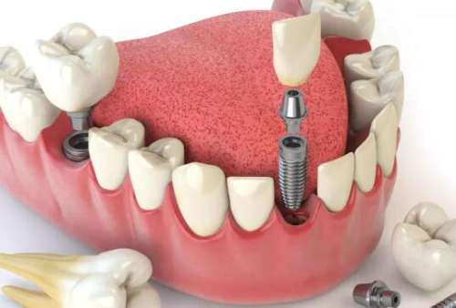 上海六院種植牙價(jià)格是多少？匯總價(jià)格標(biāo)準(zhǔn)及熱門醫(yī)生分享