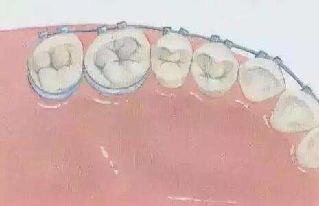 鄭大一附院牙齒矯正價格表一覽？項目費用在線分享