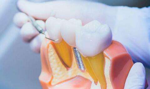 哈爾濱醫(yī)大一種植牙多少錢？分享價格標(biāo)準(zhǔn)-技術(shù)特色了解