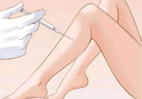 小腿吸脂 小腿吸脂