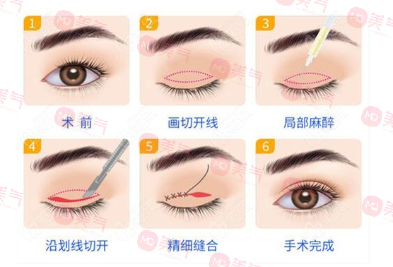 上海九院雙眼皮哪個醫(yī)生比較好？