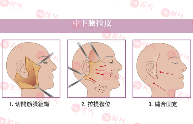 上海九院拉皮手術哪個醫(yī)生做的好？