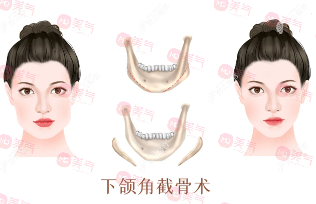 上海九院磨骨有名的醫(yī)生推薦