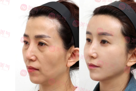 北京八大處整容醫(yī)院做拉皮多少錢？