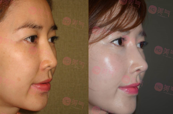 北京八大處做面部脂肪填充多少錢？