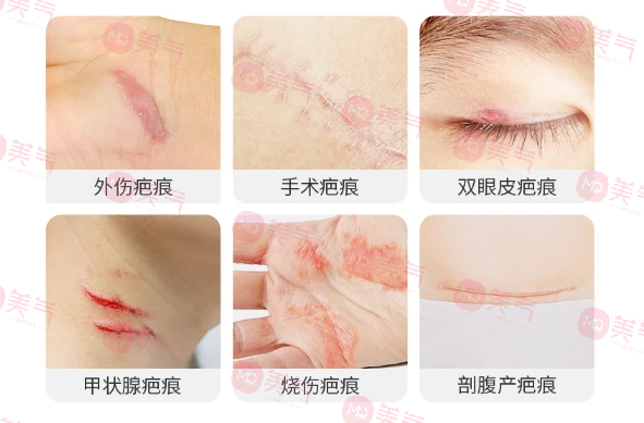 北京八大處整容醫(yī)院做疤痕修復多少錢？