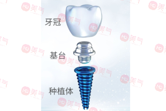 種植牙齒多少錢一顆2023？種植體品牌、醫(yī)生選擇都決定了定價！