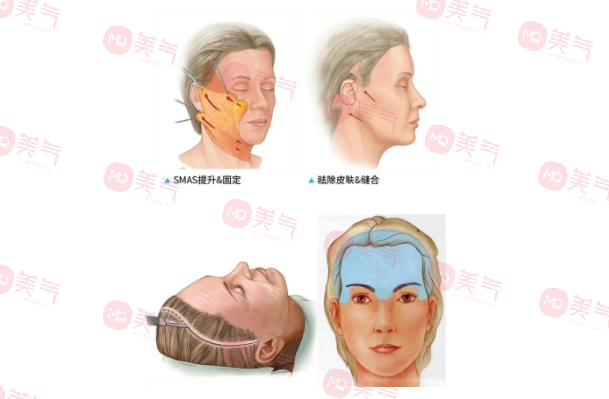 北京煤醫(yī)王馳拉皮手術(shù)多少錢？醫(yī)生技術(shù)介紹+價(jià)格表參考