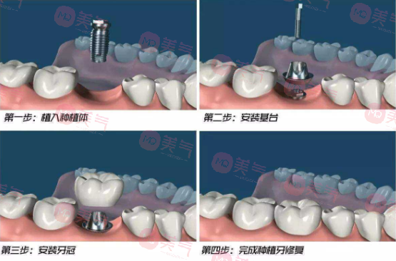 北京種植牙多少錢一顆？價格費(fèi)用_注意事項_使用年限