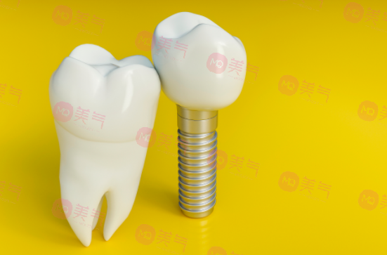 上海種植牙價格表大全更新！低至5900？內附種植牙原理、注意事項