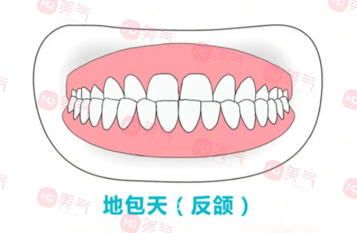 地包天矯正需要多少費(fèi)用？骨性地包天整形費(fèi)用2-4萬起