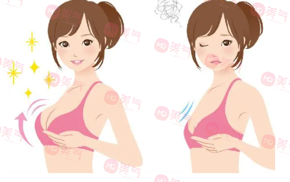 重慶豐胸得多錢？2萬的曼托假體隆胸要不要做