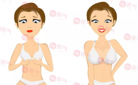 重慶豐胸得多錢？2萬(wàn)的曼托假體隆胸要不要做