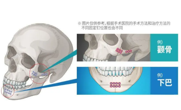 上海李志海和柴崗顴骨顴弓術(shù)手術(shù)費(fèi)用分別是多少？