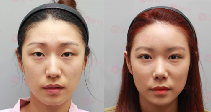 開眼角費用大概需要多少錢？