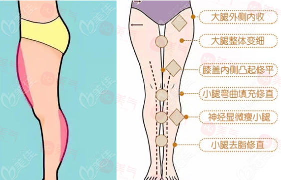臀部吸脂手術(shù)優(yōu)點(diǎn)、作用、注意事項(xiàng)介紹