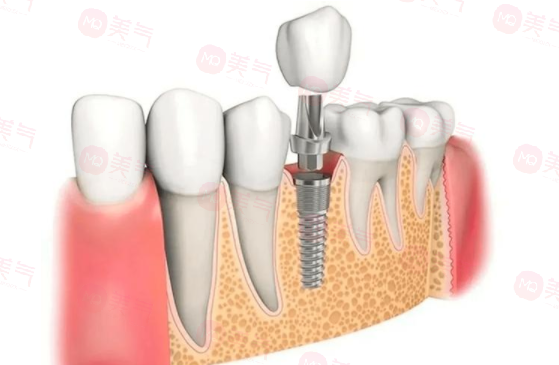 北京種牙多少錢一顆啊2024價(jià)格表，北京好的口腔醫(yī)院推薦