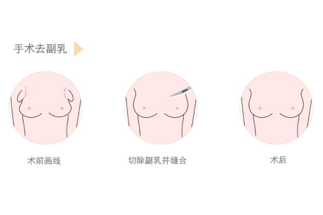 去副乳