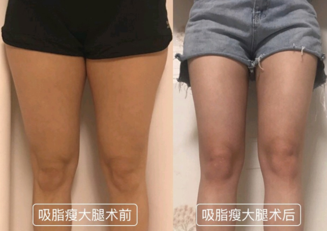 大腿吸脂