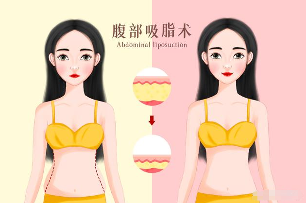 腰腹吸脂手術(shù)