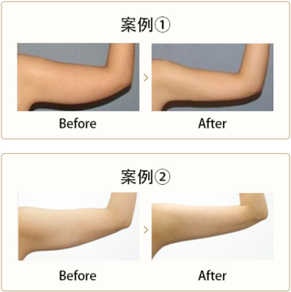 手臂吸脂手術(shù)