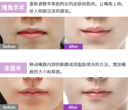 口唇整形