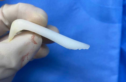 隆鼻假體取出去