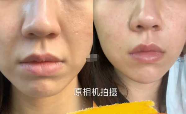 玻尿酸去法令紋