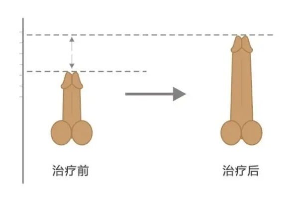 陰莖延長術(shù)