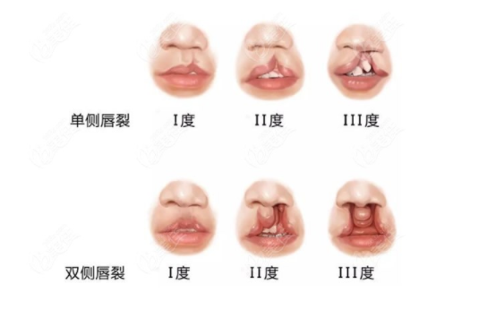 唇腭裂手術(shù)