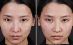 玻尿酸全臉填充