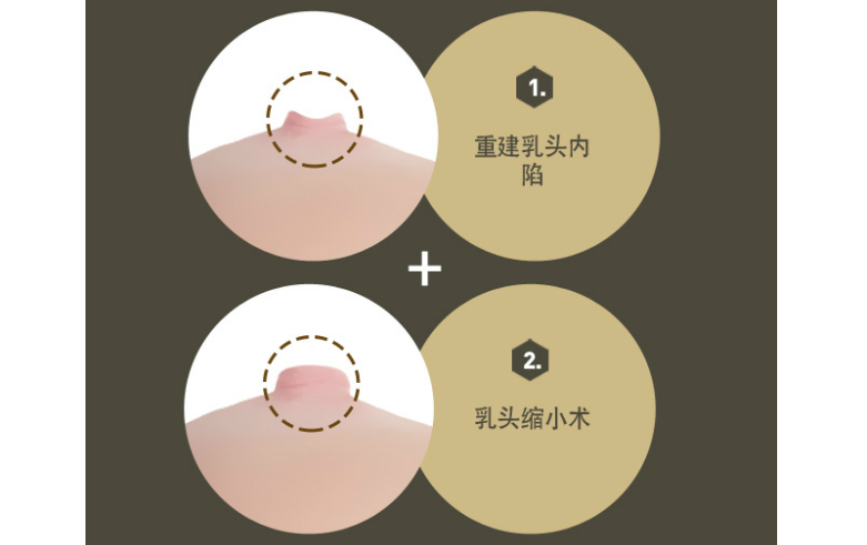 乳頭內(nèi)陷矯正